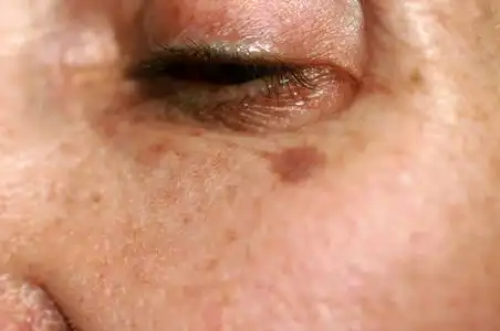 年龄斑图片-年龄斑素材-年龄斑插画-摄图新视界