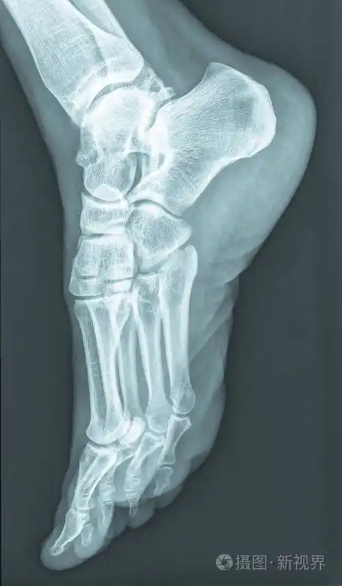 人类女性脚骨x线片