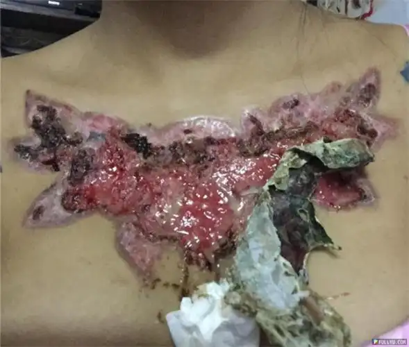 正妹女大生记录下自己「清除刺青全过程」,雪白胸口溃烂流脓「3个月后
