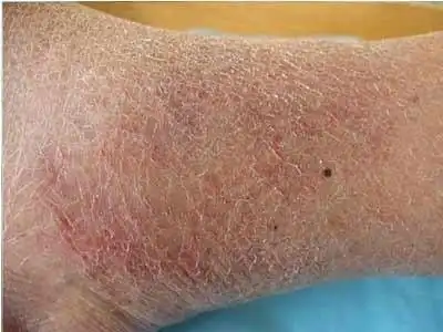 干燥性湿疹.jpg