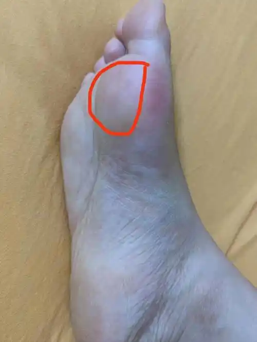 我的足底筋膜炎已经恢复了有段日子了,之前就时常感觉脚底和脚跟处有