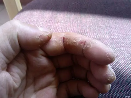 【病例讨论】持续十年的手部角化过度性湿疹