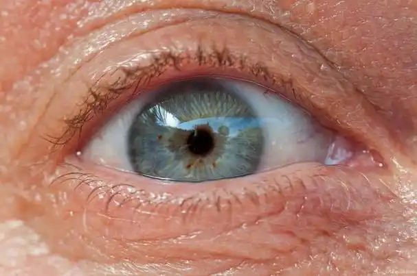 眼睛青俗称青光眼,是一种发生在眼球的眼压增高所引起的疾病.