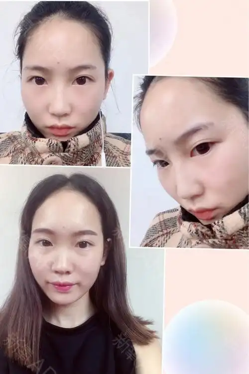 对了,给你们看下对比,之前我是山根很塌,鼻头还算秀气