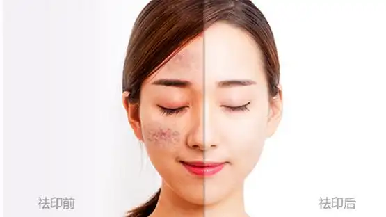 【干货】祛痘印到底哪个方法好?