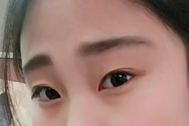 吊眼梢适合做双眼皮手术吗?