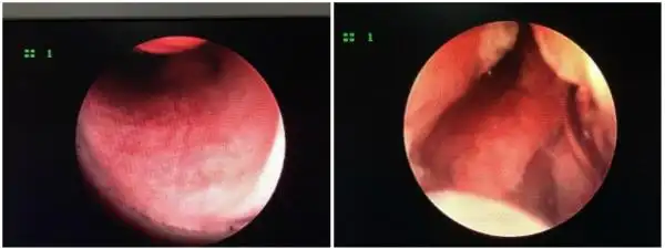 图19 鼻前庭粘膜正常;图20 大量分泌物,鼻甲骨损伤