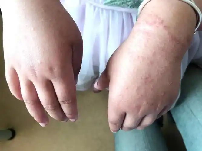 每个孩子都会出现的沙土皮炎