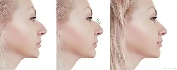 鞍鼻是一种常见的鼻部畸形,表现为鼻梁低平,鼻孔过大或过小,甚至出现