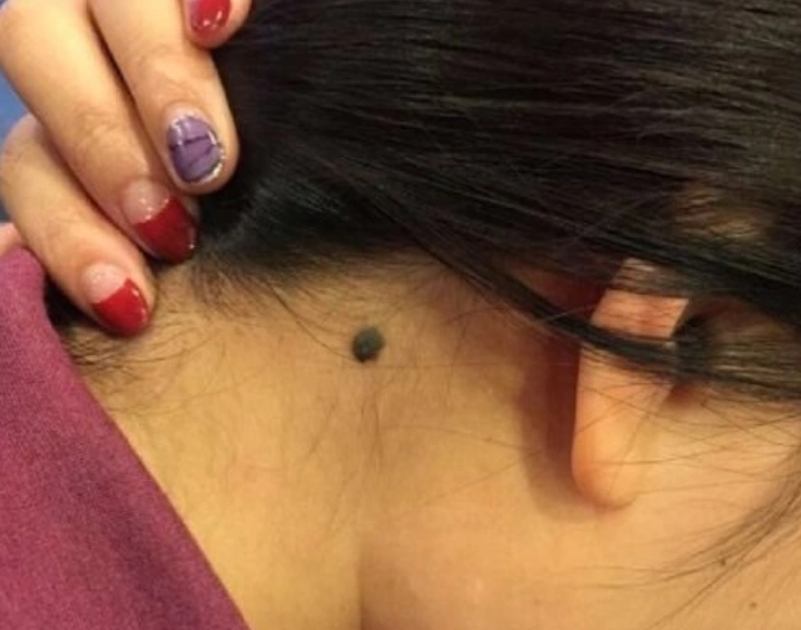 脖子后边的一颗"痣"?是好是坏?如果你也有,建议看看