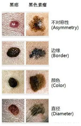 黑痣与黑色素瘤对比的图片