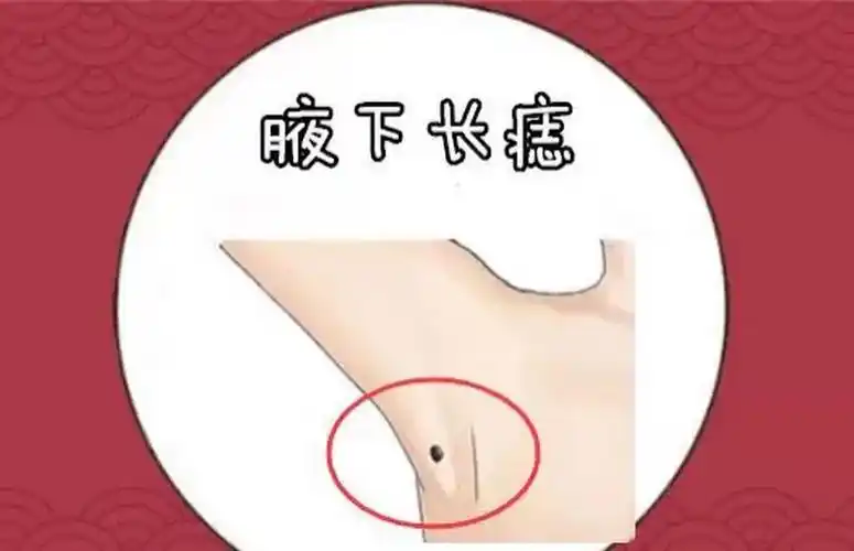 腋下长痣  在相学当中,若是在腋下的位置长有吉痣,往往会被称之为