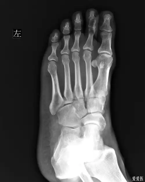 左足第五跖骨