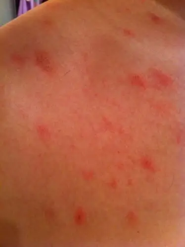身上,特别是胸口脖子处起了很多红色小疙瘩