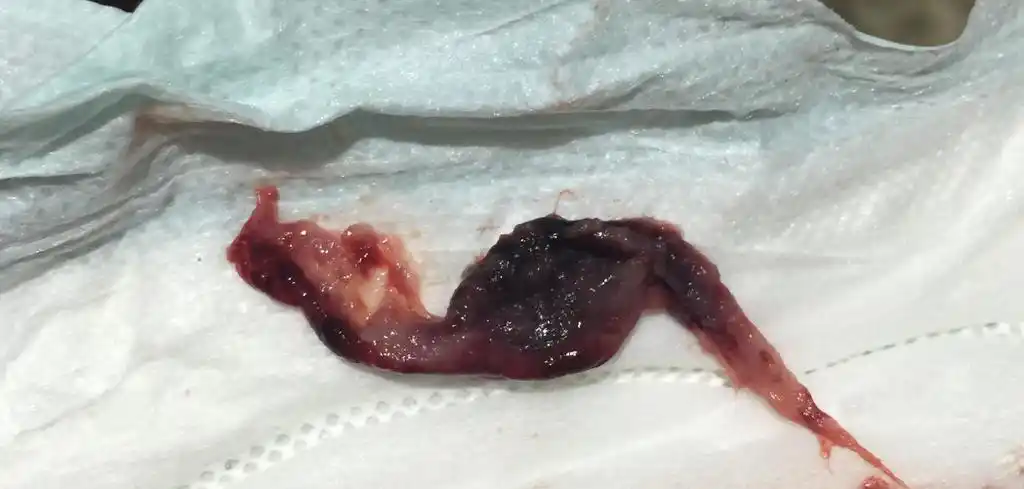 移植第十八天流出血块肉状固体是什么?是胚胎么?