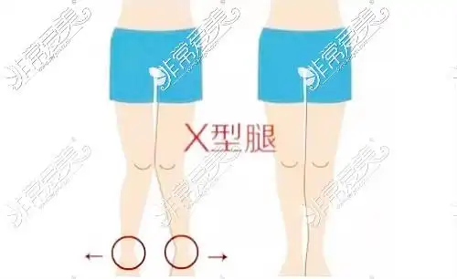 四川成都腿型矫正医院名单揭秘成都xo型腿矫正医院哪家好