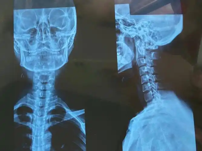 26岁 颈椎变直 椎间盘膨隆 轻度骨质增生