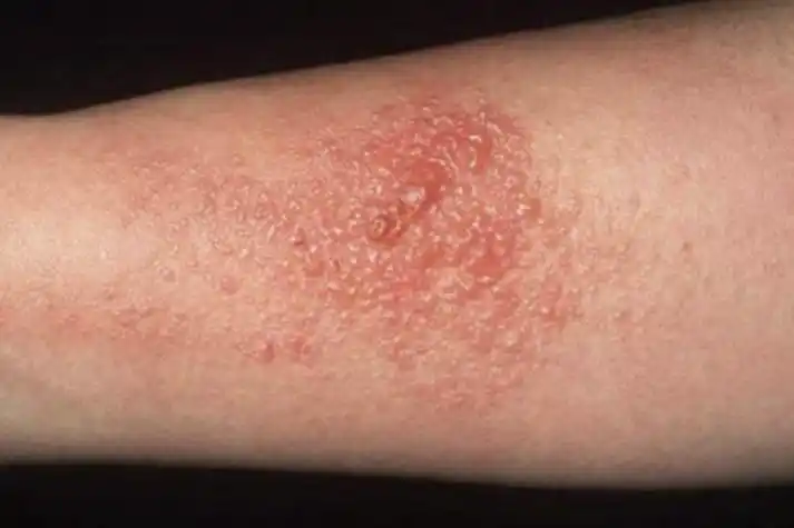 被壁虎爬过的皮肤红肿图片