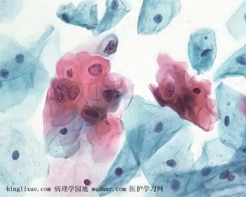 低级别鳞状上皮内病变(low-grade squamous intraepithelial lesion