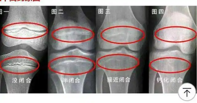 骨骼测量报告,医生告诉筱筱孩子的骨龄检测在13岁,基本上已经达到闭合