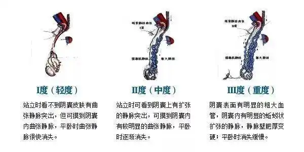男性课堂跷二郎腿竟然会精索静脉曲张