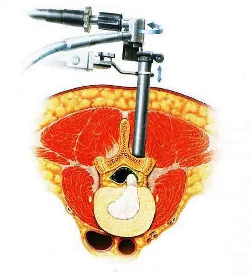 后路椎间盘镜手术示意图