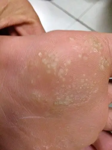 我的脚上起了好多小白点,又疼又痒又硬,想知道是什么?