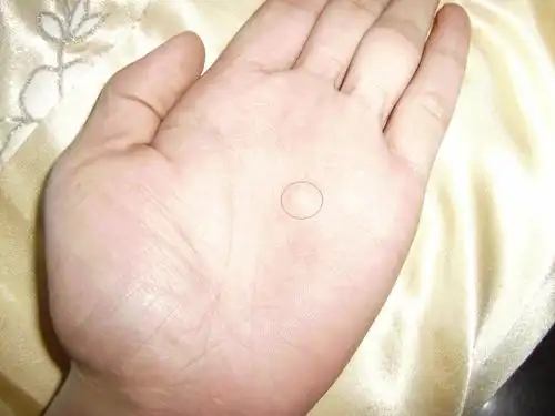 accp456| 悬赏分:20 我的左手掌有个小疙瘩,不过不痛也不痒,硬硬的