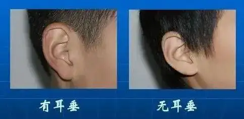 有耳垂和没耳垂的区别有耳垂跟没有耳垂人的命运区别