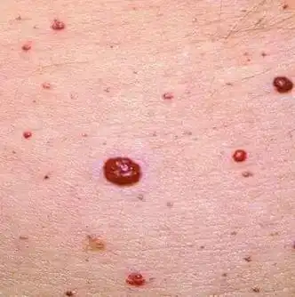 樱桃状血管瘤怎么治疗?