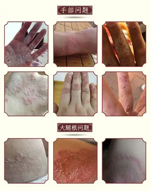 紫椒癣町酊牛皮l癣银l屑病头皮l癣手紫椒癣町酊牛头虎毒共发5盒巩固