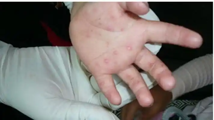 手足口病初期症状图片及治疗法 (58)