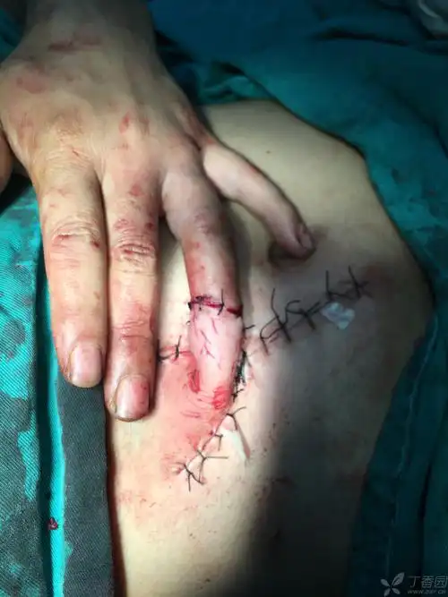 腹部皮瓣修复创面一例 [病例帖]