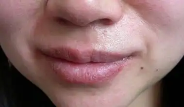 嘴唇究竟做错了什么?-唇炎全攻略