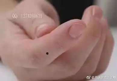 食指痣代表有事业心,勇敢,喜照顾他人.