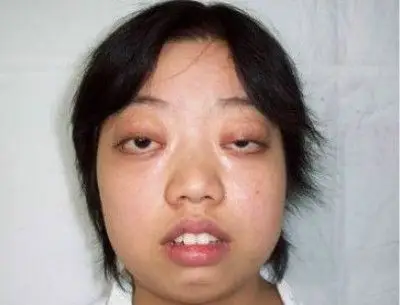甲亢突眼图片_甲亢突眼症状表现图片大全_有来医生