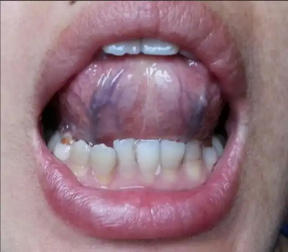 健康隐患早知道, 伸伸舌头百病消!