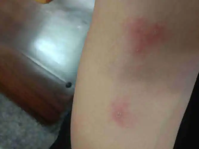 被虫子在胳膊上咬了,看起来感觉挺严重,但是又不痛.