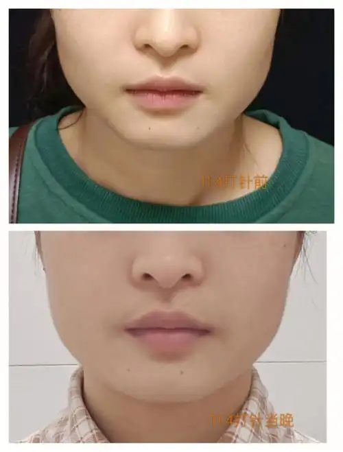 瘦脸针(保妥适)一周变化