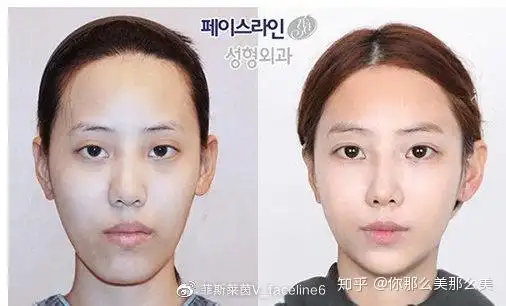 额头缩小术对比照片