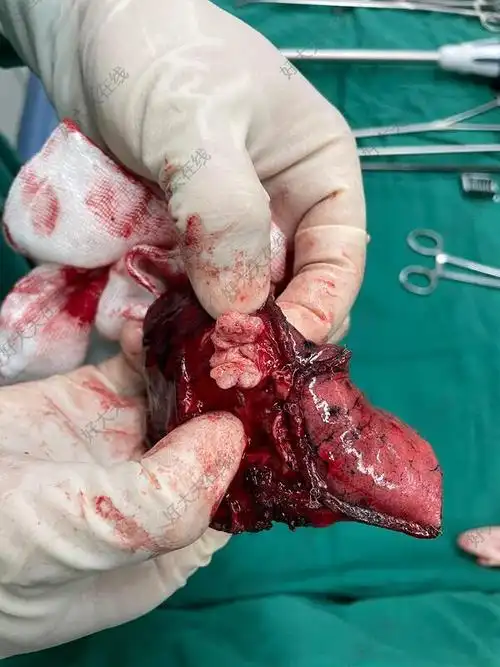 右s3b亚段切除_肺切除手术 - 好大夫在线