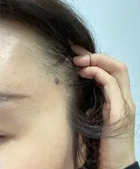 不知道什么时候发际线这个位置长了一颗小痣,这两年总有点痒痒的,偶尔