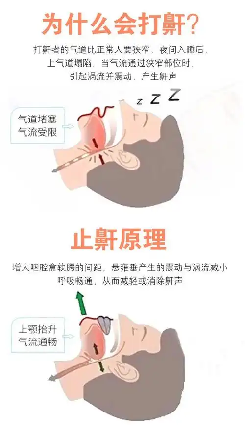 打鼾让人无法睡觉草本鼾立停轻轻一喷告别打鼾一觉到天亮