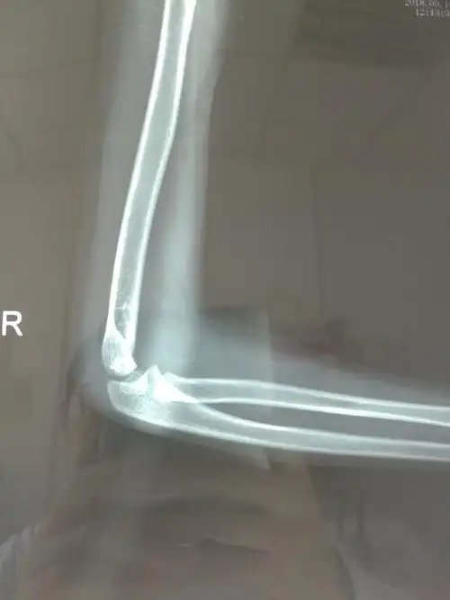 儿童肱骨远端骨折