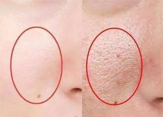 螨虫脸早晚揉一揉洗出陈年脏东西q弹皮肤终于回来了