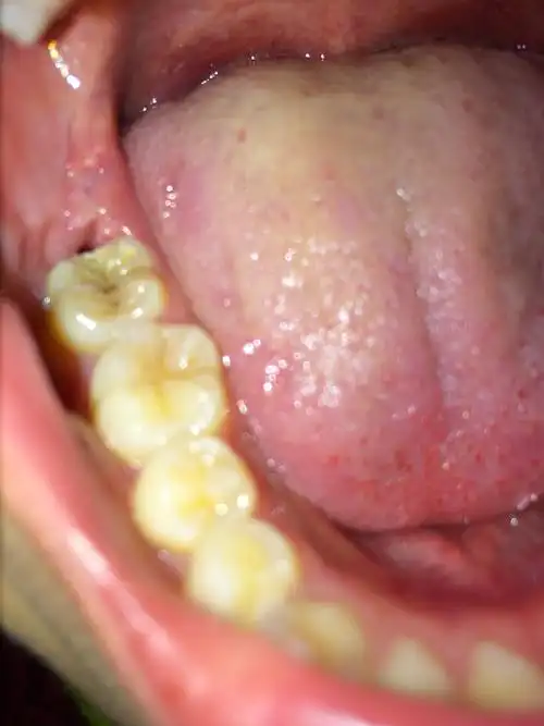 因为矫正拔了这个智齿,将近一个月了,智齿前面的一颗牙后面有个很深的