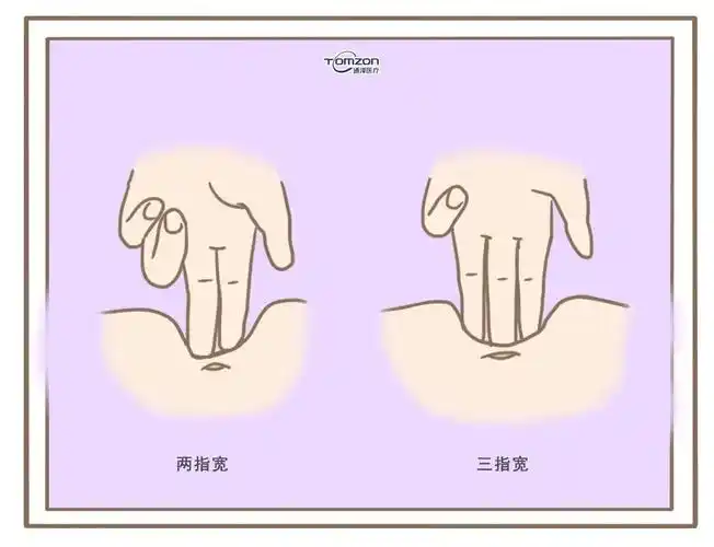 腹直肌分离的临床诊断标准诊断标准:触诊确定脐水平连线与两侧腹直肌