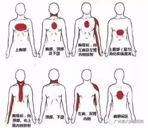 心梗高发季节这些症状你要知道