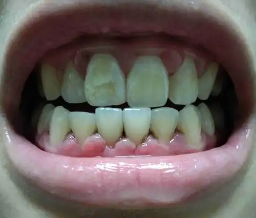 自己一口烂牙,门牙有黄斑和白斑不知道是氟斑牙还是牙釉质脱矿?