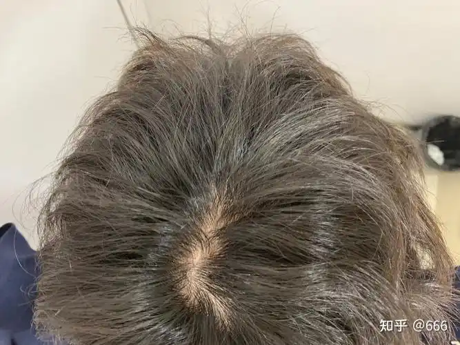 这样的发旋是不是秃顶前兆